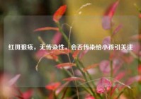 红斑狼疮，无传染性，会否传染给小孩引关注